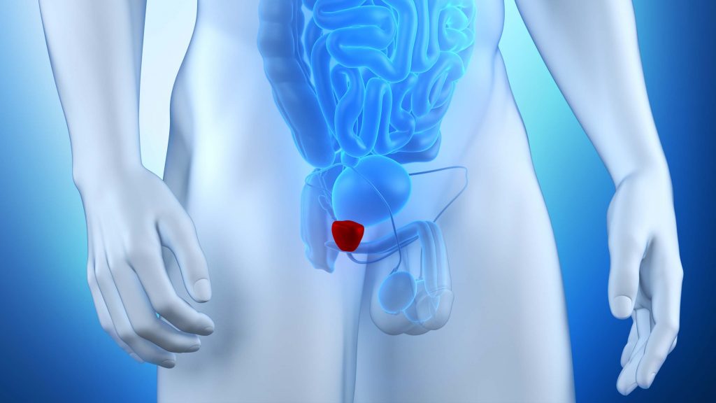 Cirurgia Robótica na Prostatectomia Simples para Tratamento da Hiperplasia Prostática Benigna