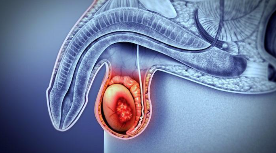 Câncer de Testículo e a Cirurgia Robótica: uma abordagem interessante